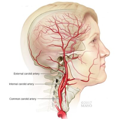 Carotid arteryOpen pop-up dialog box