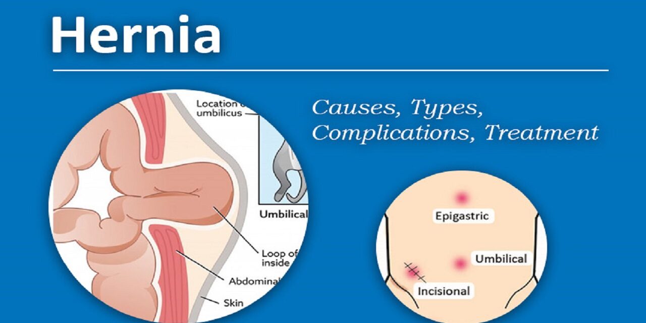 What is a hernia, its cause, symptoms, treatment, and prevention? -  Infinity Care Hospital