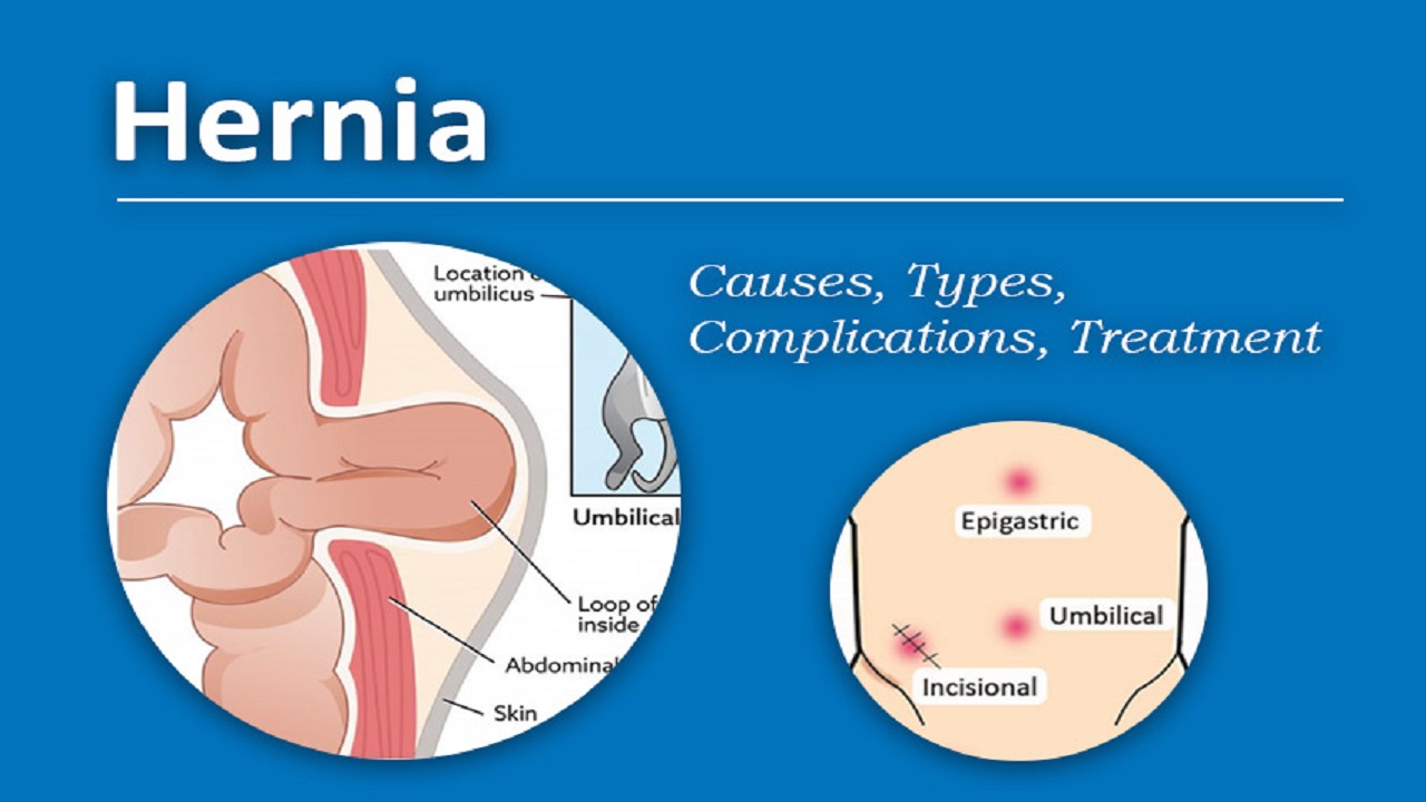 Hernia: Causes, treatments, and diagnosis